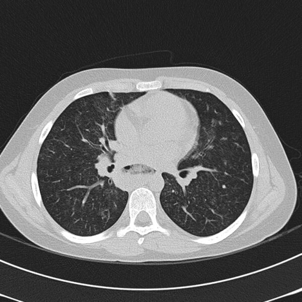 File:Achalasia (Radiopaedia 14946-14878 Axial lung window 40).jpg