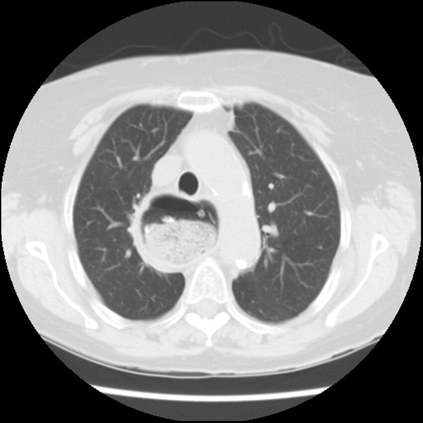 Achalasia (Radiopaedia 44094-47649 Axial lung window 18).jpg