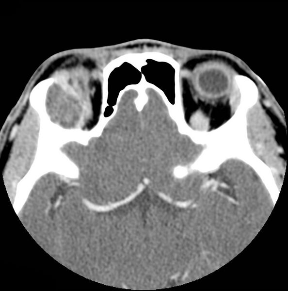 File:Acinic cell carcinoma of the lacrimal gland (Radiopaedia 9480-10160 Axial C+ arterial phase 10).jpg
