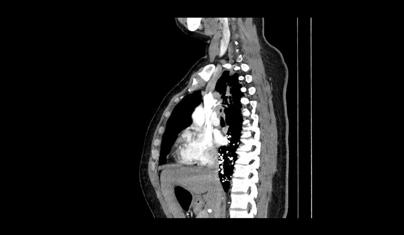 File:Acquired tracheo-esophageal fistula (Radiopaedia 51356-57103 Sagittal C+ arterial phase 9).jpg