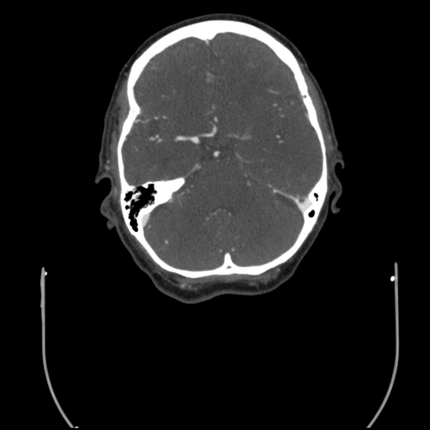 Acute M1 occlusion with ischemic penumbra (CT perfusion) (Radiopaedia 71897-82344 Axial C+ arterial phase thins 92).jpg