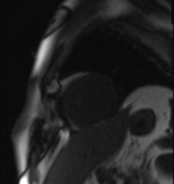 File:Acute anteroseptal myocardial infarction (Radiopaedia 68409-77945 Short axis (mid ventricular) Perfusion 1).jpg