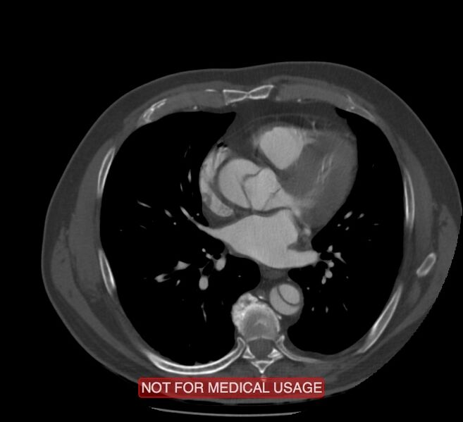 File:Acute aortic dissection - Stanford type A (Radiopaedia 40661-43285 Axial C+ arterial phase 38).jpg