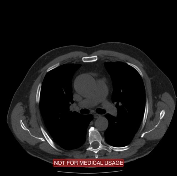 File:Acute aortic dissection - Stanford type A (Radiopaedia 40661-43285 Axial non-contrast 20).jpg