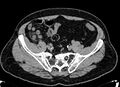 Acute appendicitis (Radiopaedia 13030-13091 Axial non-contrast 45).jpg