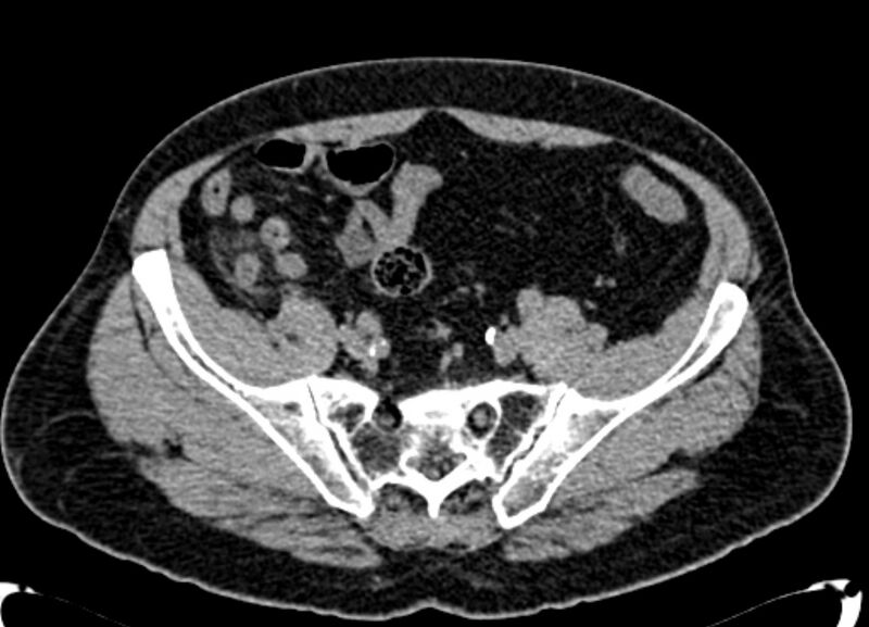 File:Acute appendicitis (Radiopaedia 13030-13091 Axial non-contrast 45).jpg