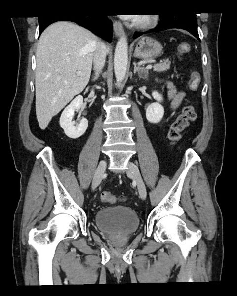 File:Acute appendicitis - large appendicoliths (Radiopaedia 61805-69820 Coronal C+ portal venous phase 76).jpg
