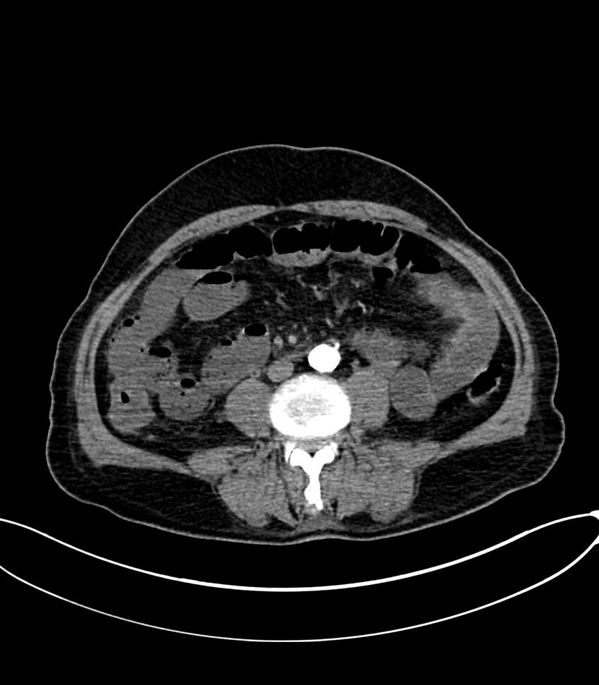 Acute arterial mesenteric ischemia (Radiopaedia 78238-90828 Axial C+ arterial phase 77).jpg