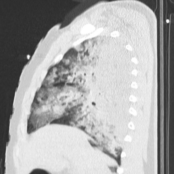 File:Acute aspiration pneumonitis (Radiopaedia 33605-34703 Sagittal lung window 32).jpg