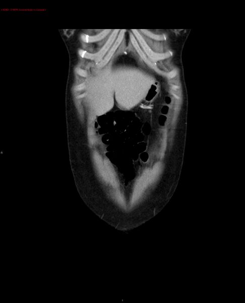 File:Acute gastritis (Radiopaedia 21043-20975 Coronal C+ portal venous phase 27).jpg