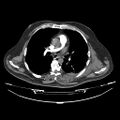 Acute heart failure (CT) (Radiopaedia 79835-93075 Axial C+ arterial phase 14).jpg