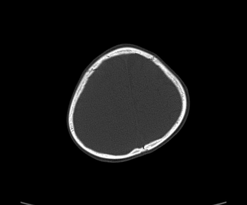 Acute hemorrhagic contusion (Radiopaedia 63660-72336 Axial bone window 57).jpg