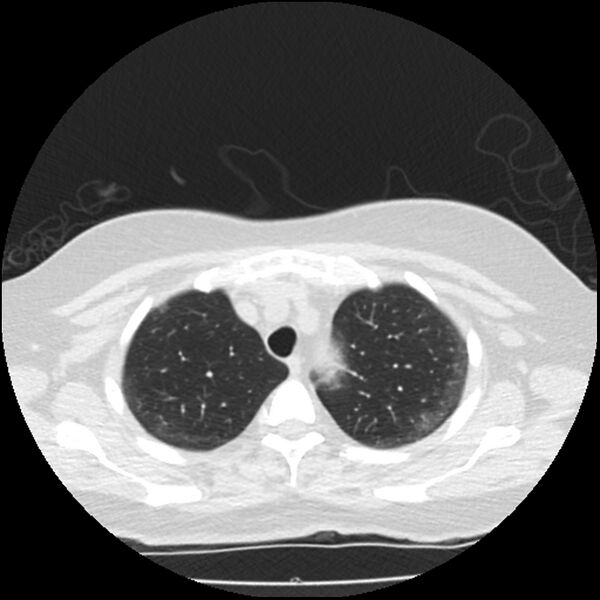 File:Acute interstitial pneumonitis (Radiopaedia 45404-49444 Axial lung window 21).jpg
