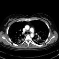 Acute myocardial infarction in CT (Radiopaedia 39947-42415 Axial C+ arterial phase 49).jpg