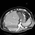 Acute pancreatic necrosis (Radiopaedia 13560-18502 Axial C+ portal venous phase 2).jpg