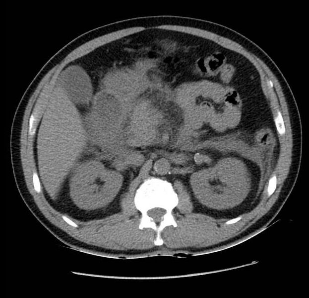 File:Acute pancreatitis - Balthazar E (Radiopaedia 23080-23110 Axial non-contrast 26).jpg