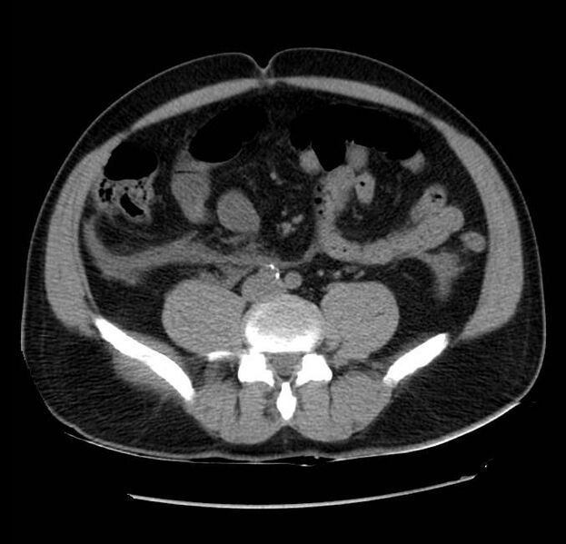 File:Acute pancreatitis - Balthazar E (Radiopaedia 23080-23110 Axial non-contrast 45).jpg