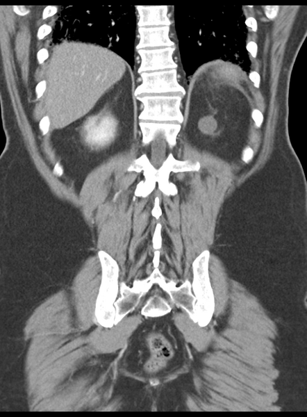 File:Acute pancreatitis complicated by portal vein thrombus (Radiopaedia 48148-52990 Coronal C+ portal venous phase 50).png