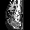 Acute pyelonephritis (Radiopaedia 25657-25837 Sagittal renal parenchymal phase 43).jpg