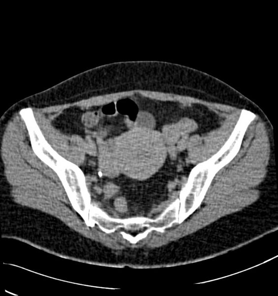 File:Acute pyelonephritis (Radiopaedia 40264-42816 Axial renal excretory phase 29).jpg