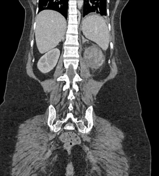 File:Acute pyelonephritis with renal vein thrombosis (Radiopaedia 58020-65053 Coronal renal parenchymal phase 95).jpg