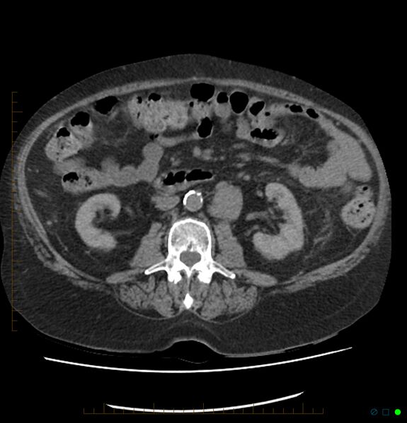 File:Acute renal failure post IV contrast injection- CT findings (Radiopaedia 47815-52557 Axial non-contrast 39).jpg