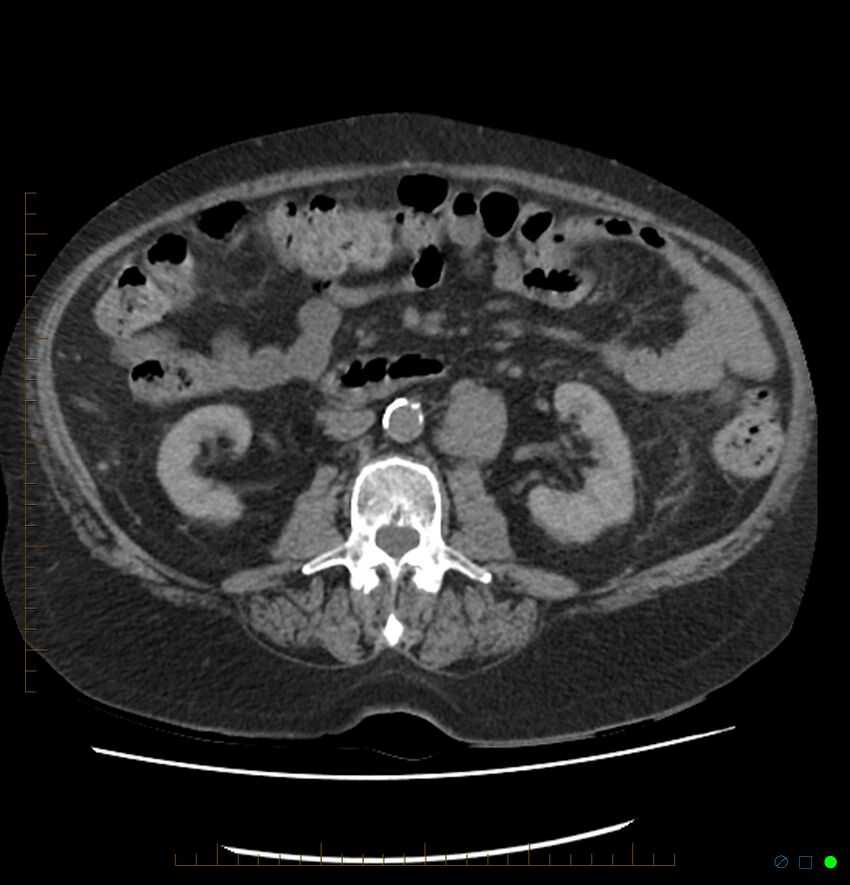 Acute renal failure post IV contrast injection- CT findings (Radiopaedia 47815-52557 Axial non-contrast 39).jpg
