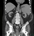 Acute renal failure post IV contrast injection- CT findings (Radiopaedia 47815-52557 Coronal non-contrast 29).jpg