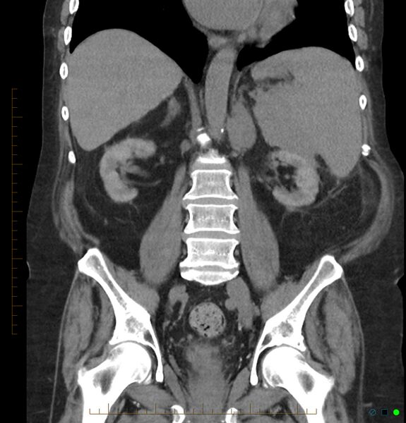 File:Acute renal failure post IV contrast injection- CT findings (Radiopaedia 47815-52557 Coronal non-contrast 29).jpg