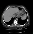 Acute renal failure post IV contrast injection- CT findings (Radiopaedia 47815-52559 Axial C+ portal venous phase 11).jpg