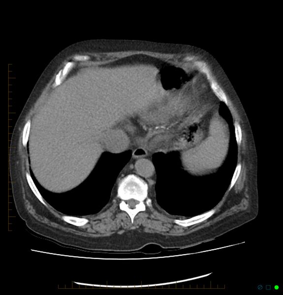 File:Acute renal failure post IV contrast injection- CT findings (Radiopaedia 47815-52559 Axial C+ portal venous phase 11).jpg