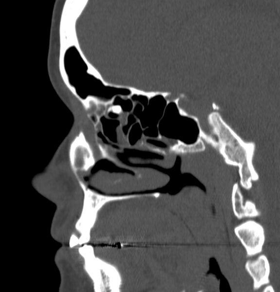 File:Acute sinusitis (Radiopaedia 22419-22455 Sagittal non-contrast 10).jpg