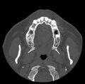 Acute sinusitis (Radiopaedia 23161-23215 Axial bone window 5).jpg