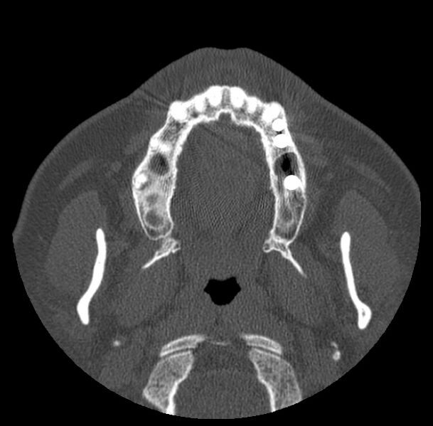 File:Acute sinusitis (Radiopaedia 23161-23215 Axial bone window 5).jpg