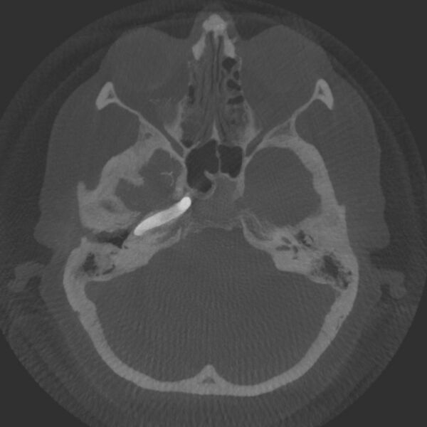 File:Acute subarachnoid hemorrhage and accessory anterior cerebral artery (Radiopaedia 69231-79010 Axial arterial - MIP 16).jpg