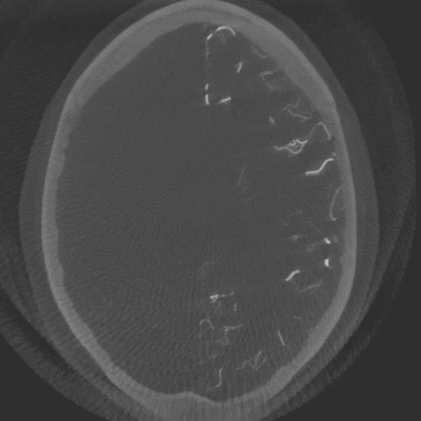 Acute subarachnoid hemorrhage and accessory anterior cerebral artery (Radiopaedia 69231-79010 C 48).jpg
