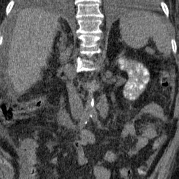 File:Acute tubular necrosis (Radiopaedia 28077-28334 C 7).jpg