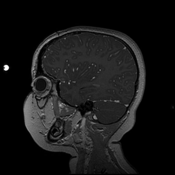 File:Adamantinomatous craniopharyngioma (Radiopaedia 77407-89529 H 90).jpg