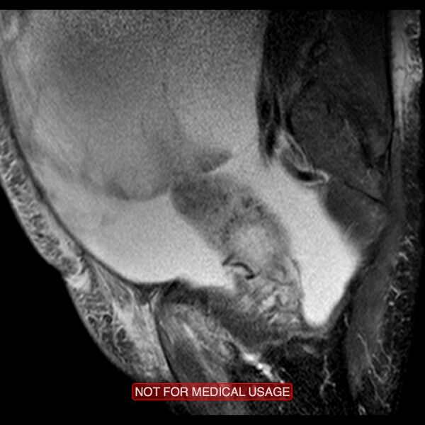 File:Adenocarcinoma of the cervix (Radiopaedia 28373-28615 Sagittal T2 fat sat 14).jpg