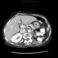 Adenocarcinoma of the colon (Radiopaedia 8191-9039 Axial liver window 23).jpg