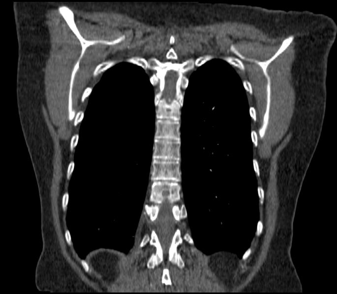 File:Adenocarcinoma of the lung (Radiopaedia 44205-47803 Coronal C+ portal venous phase 80).jpg