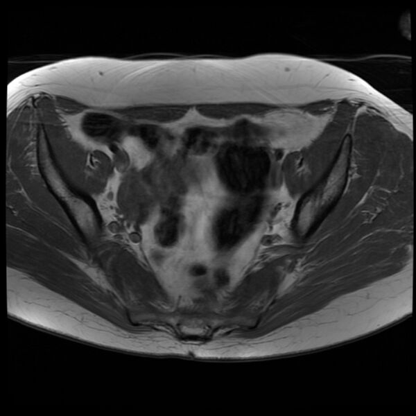 File:Adenoma malignum of the cervix (Radiopaedia 24460-24765 T1 7).jpg