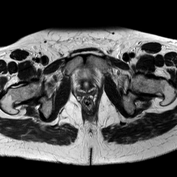 File:Adenomyoma of the uterus (Radiopaedia 9871-10439 Axial T2 6).jpg