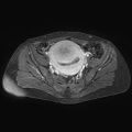 Adenomyoma of the uterus (huge) (Radiopaedia 9870-10438 Axial T1 C+ fat sat 20).jpg