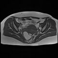 Adenomyosis and endometriotic cysts (Radiopaedia 82300-96367 Axial T1 16).jpg