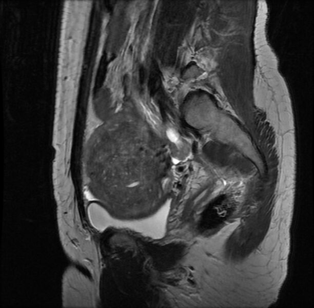 File:Adenomyosis on MRI (Radiopaedia 29328-29780 Sagittal T2 4).jpg