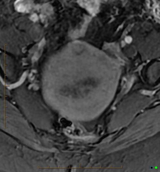 File:Adenomyosis uterus with hematometra (Radiopaedia 45779-50011 Axial T1 C+ fat sat 13).jpg