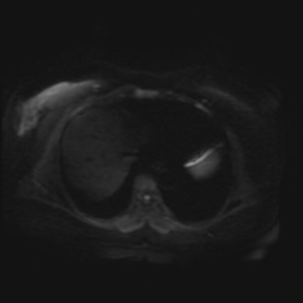 File:Adrenal cortical carcinoma (Radiopaedia 70906-81116 Axial DWI 2).jpg