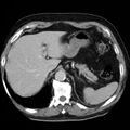 Adrenal hemangioma (Radiopaedia 11039-11445 Axial C+ portal venous phase 1).jpg