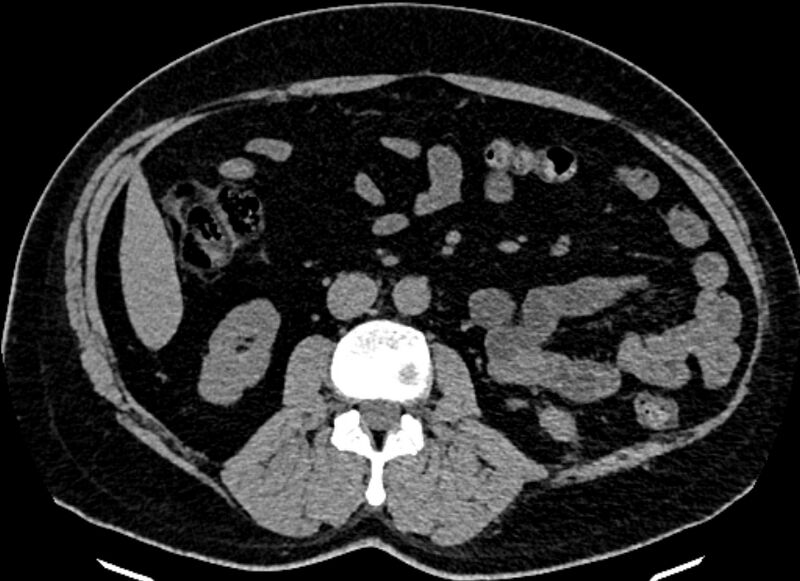 File:Adrenal metastases (Radiopaedia 73082-83791 Axial non-contrast 94).jpg
